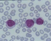 leucemia-no-sangue-8