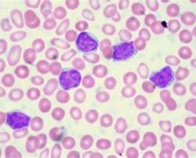 leucemia-no-sangue-9