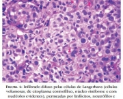 neuropatia-periferica-tratamento-29