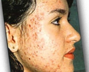 acne-4