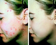 acne-7