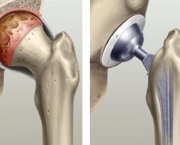 O Que é Prótese Ortopédica (2)