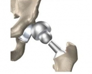 O Que é Prótese Ortopédica (16)