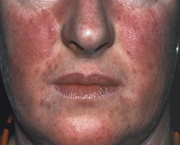 o-que-e-rosacea-e-como-cuidar-1