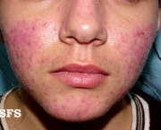 o-que-e-rosacea-e-como-cuidar-2