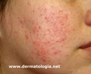 o-que-e-rosacea-e-como-cuidar-3