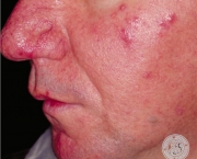 o-que-e-rosacea-e-como-cuidar-5