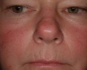 o-que-e-rosacea-e-como-cuidar-6