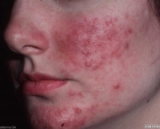 o-que-e-rosacea-e-como-cuidar-8