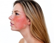 o-que-e-rosacea-e-como-cuidar-9