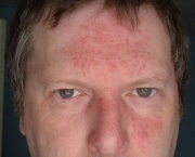 o-que-e-rosacea-e-como-cuidar-10