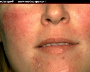 o-que-e-rosacea-e-como-cuidar-11