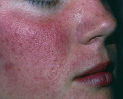 o-que-e-rosacea-e-como-cuidar-13