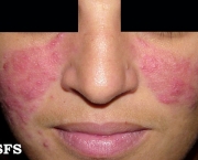 o-que-e-rosacea-e-como-cuidar-15