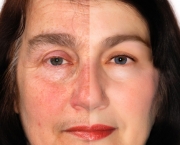 o-que-e-rosacea-e-como-cuidar-16