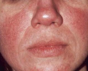 o-que-e-rosacea-e-como-cuidar-17