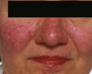 o-que-e-rosacea-e-como-cuidar-18