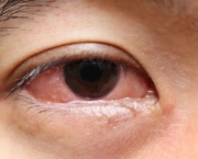 Causas do Olho Seco (6)