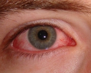 Causas do Olho Seco (14)