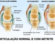 Os Princípios Da Artrite (4)