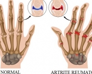 Os Princípios Da Artrite (5)