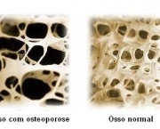 osteoporose-e-infarto-1