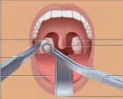 outras-tecnicas-de-remover-as-amidalas-a-anestesia-para-a-tonsilectomia-e-a-tonsilectomia-2