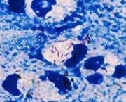 perigos-da-tuberculose-4
