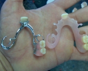 Prótese Dentária de Silicone Fixa (1)