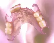 Prótese Dentária de Silicone Fixa (12)