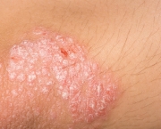 Psoriase (1)