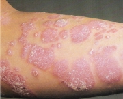 Psoriase (1)