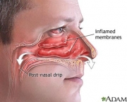 quais-as-causas-da-anosmia-3