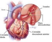 qual-o-significado-de-infarto-do-miocardio-parte-2-3