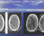 significado-de-infarto-cerebral-na-ciencia-1