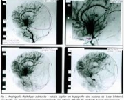 significado-de-infarto-cerebral-na-ciencia-4