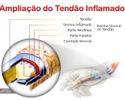 tendinites-12
