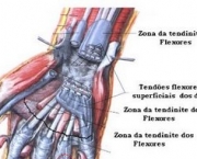 tendinites-6