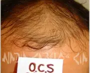 tratamento-contra-calvicie-3