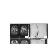 tratamento-no-infarto-cerebral-3