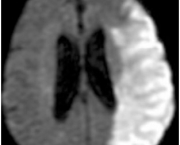 tratamento-no-infarto-cerebral-4