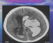 tratamento-no-infarto-cerebral-5