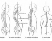 tratamento-para-escoliose2