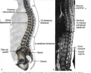 tratamento-para-escoliose7