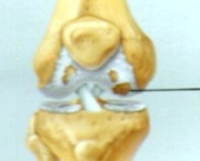 tratamentos-da-osteoartrose-de-joelho1