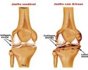 tratamentos-da-osteoartrose-de-joelho10
