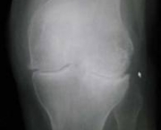 tratamentos-da-osteoartrose-de-joelho14