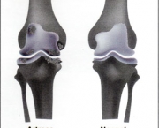 tratamentos-da-osteoartrose-de-joelho15