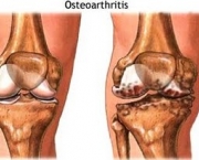tratamentos-da-osteoartrose-de-joelho4