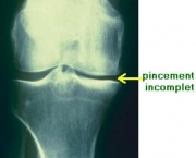 tratamentos-da-osteoartrose-de-joelho9